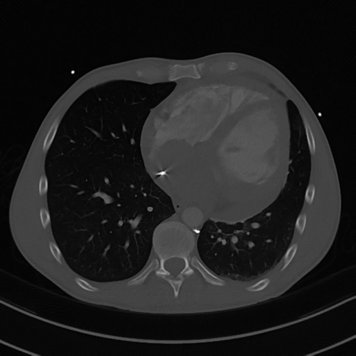 File:Cardiac tumor - undifferentiated pleomorphic sarcoma (Radiopaedia 45844-50134 Axial bone window 46).png