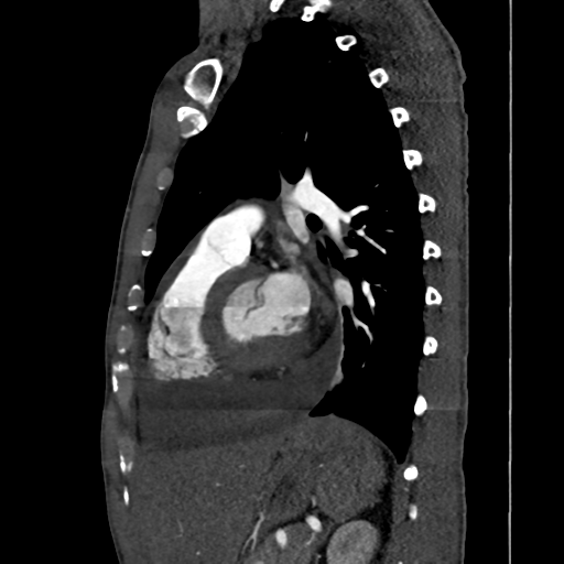 File:Cardiac tumor - undifferentiated pleomorphic sarcoma (Radiopaedia 45844-50134 B 27).png