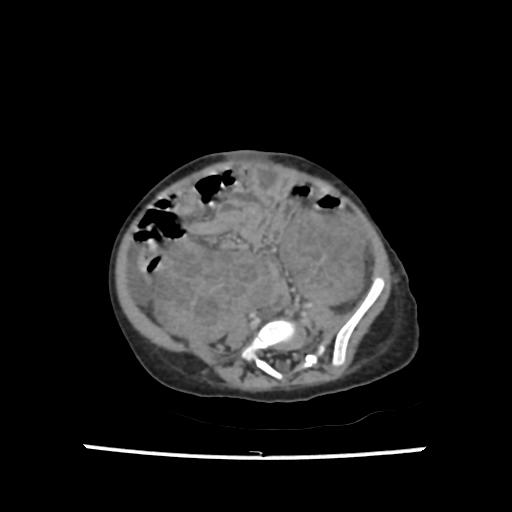 Caroli disease with autosomal recessive polycystic kidney disease (ARPKD) (Radiopaedia 89651-106703 B 162).jpg