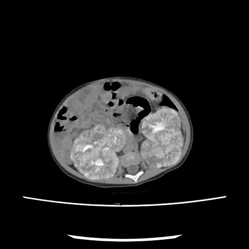 File:Caroli disease with autosomal recessive polycystic kidney disease (ARPKD) (Radiopaedia 89651-106703 E 121).jpg