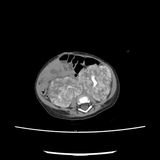 File:Caroli disease with autosomal recessive polycystic kidney disease (ARPKD) (Radiopaedia 89651-106703 E 153).jpg