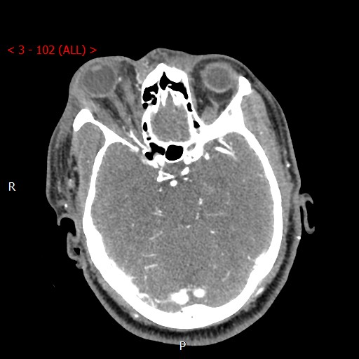 Caroticocavernous fistula (Radiopaedia 42346-45457 B 33).jpg