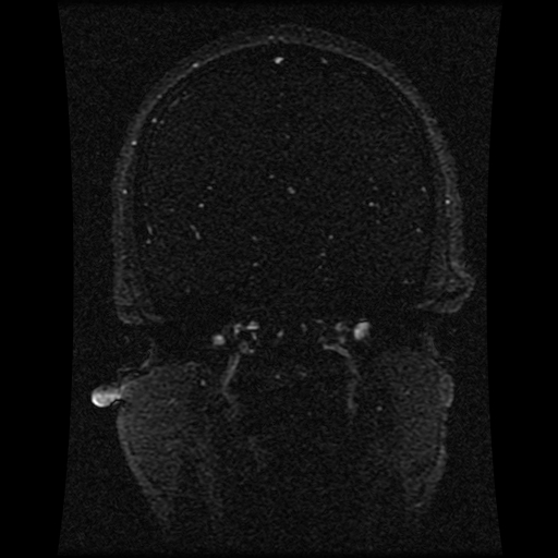 Carotid arterial dissection with acute cerebral infarction (Radiopaedia 26636-26784 MRV 94).jpg