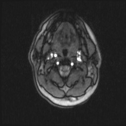 Carotid artery dissection (Radiopaedia 28441-28689 Axial MRA 48).jpg