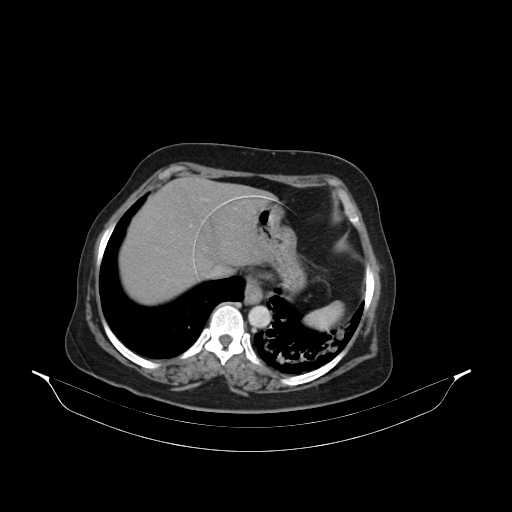 File:Carotid body tumor (Radiopaedia 21021-20948 B 55).jpg