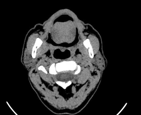 File:Carotid body tumor (Radiopaedia 61750-69757 Axial non-contrast 19).jpg