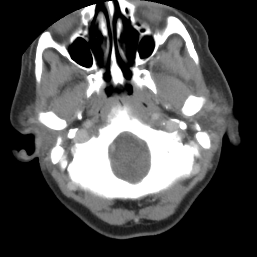 Carotid body tumor (paraganglioma) (Radiopaedia 38586-40729 A 6).jpg