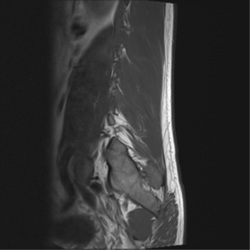 File:Cauda equina syndrome (Radiopaedia 53615-59672 Axial T1 1).png