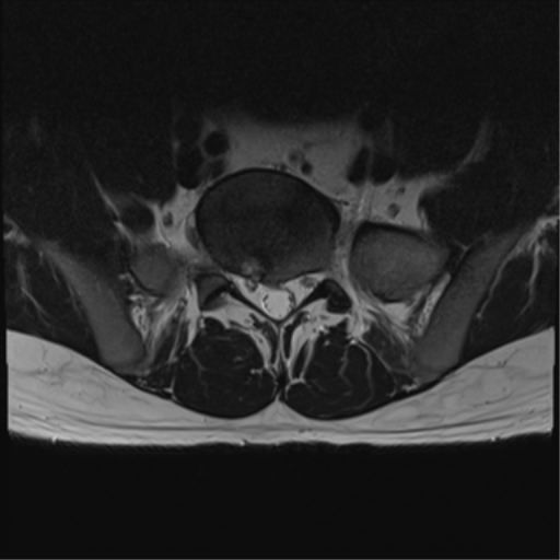 File:Cauda equina syndrome (Radiopaedia 53615-59672 Axial T2 6).png