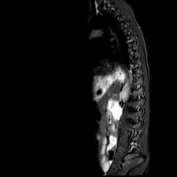 File:Caudal regression syndrome (Radiopaedia 61990-70072 Sagittal T2 TIRM 9).jpg