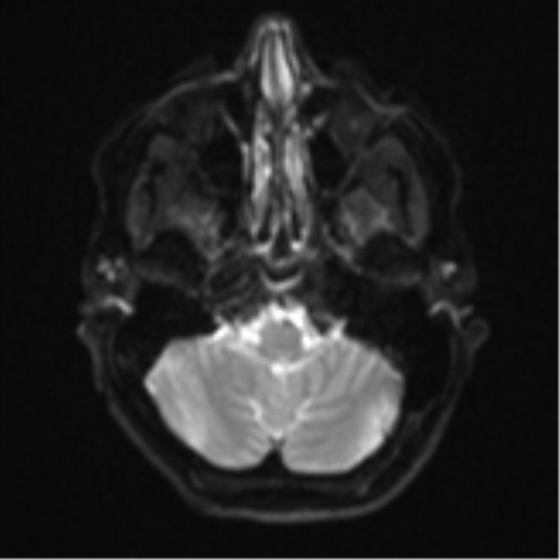 File:Cavernoma with bleed - midbrain (Radiopaedia 54546-60774 Axial DWI 4).png