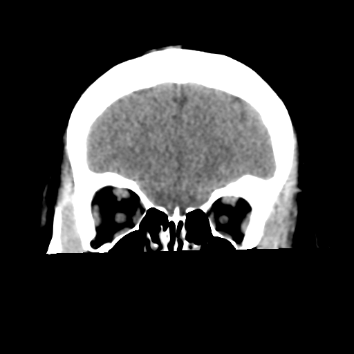 Cavernoma with hemorrhage (Radiopaedia 70755-80931 Coronal non-contrast 15).png