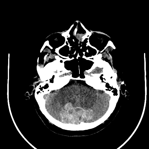 Cavernous hemangioma of the cerebellar falx (Radiopaedia 73025-83723 Axial non-contrast 31).jpg