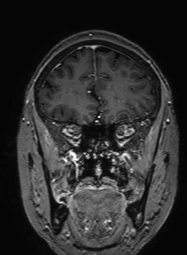 Cavernous hemangioma of the cerebellar falx (Radiopaedia 73025-83724 Coronal T1 C+ 103).jpg