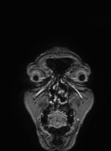 Cavernous hemangioma of the cerebellar falx (Radiopaedia 73025-83724 Coronal T1 C+ 11).jpg