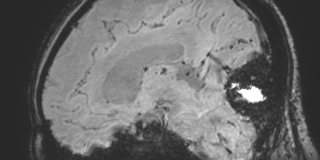 Cavernous hemangioma of the cerebellar falx (Radiopaedia 73025-83724 Sagittal BOLD 112).jpg