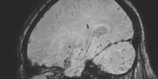 Cavernous hemangioma of the cerebellar falx (Radiopaedia 73025-83724 Sagittal BOLD 145).jpg