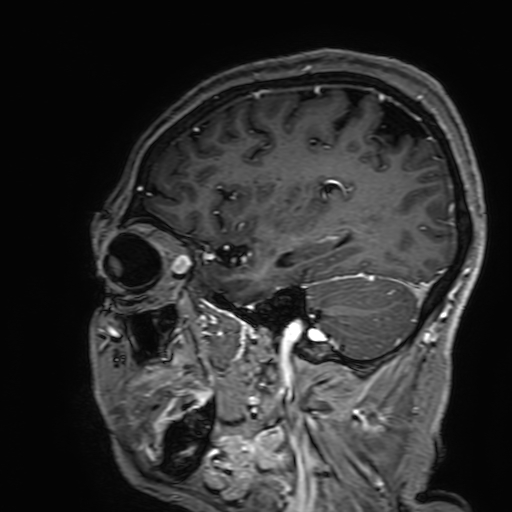 Cavernous hemangioma of the cerebellar falx (Radiopaedia 73025-83724 Sagittal T1 C+ 156).jpg