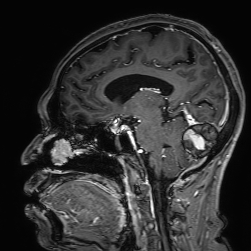 File:Cavernous hemangioma of the cerebellar falx (Radiopaedia 73025-83724 Sagittal T1 C+ 95).jpg