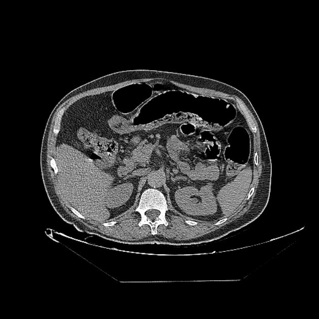 Cavitating bronchogenic carcinoma (Radiopaedia 44489-48162 Axial non-contrast 102).jpg