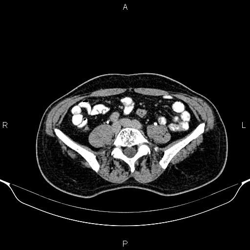 Cecal adenocarcinoma (Radiopaedia 85324-100916 Axial C+ delayed 65).jpg