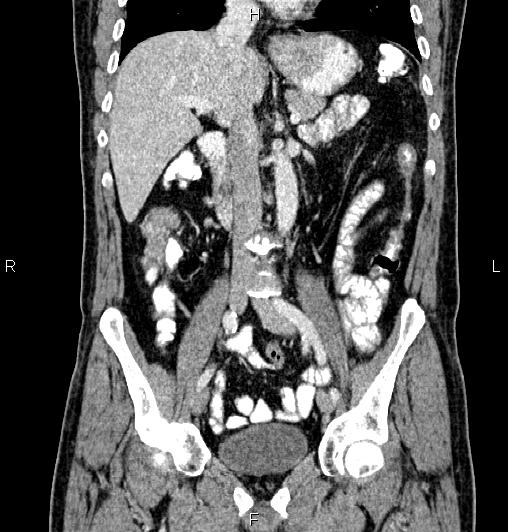 Cecal adenocarcinoma (Radiopaedia 85324-100916 D 31).jpg