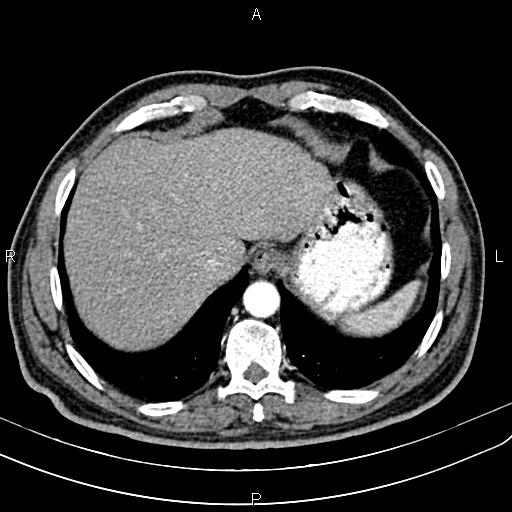 Cecal cancer with appendiceal mucocele (Radiopaedia 91080-108651 A 55).jpg
