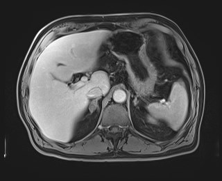 Cecal mass causing appendicitis (Radiopaedia 59207-66532 J 39).jpg