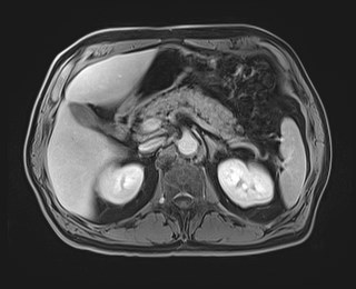 Cecal mass causing appendicitis (Radiopaedia 59207-66532 J 47).jpg
