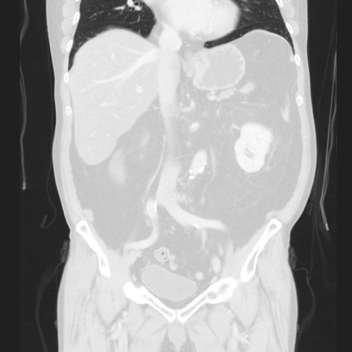 Cecal volvulus (Radiopaedia 75378-86620 Coronal lung window 75).jpg