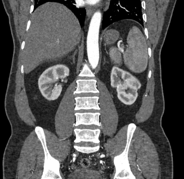 Celiac artery dissection (Radiopaedia 52194-58080 C 97).jpg