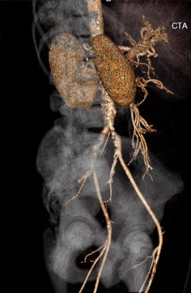 File:Celiac artery severe stenosis and dissection (Radiopaedia 44128-47842 C+ arterial phase 10).jpg