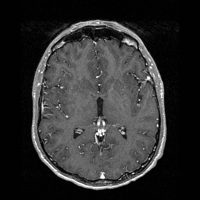 Central-variant posterior reversible encephalopathy syndrome (PRES) (Radiopaedia 43880-47358 Axial T1 C+ 82).jpg