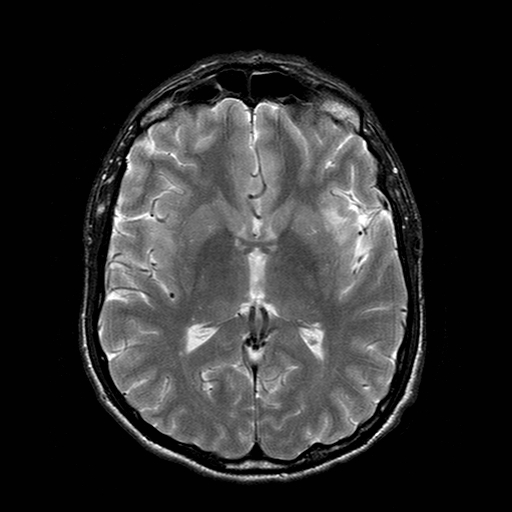 File:Central-variant posterior reversible encephalopathy syndrome (PRES) (Radiopaedia 43880-47358 Axial T2 12).jpg