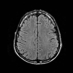 File:Central-variant posterior reversible encephalopathy syndrome (PRES) (Radiopaedia 43880-47359 Axial FLAIR 17).jpg