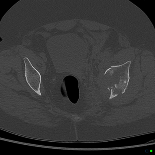 Central fracture-dislocation of the acetabulum (Radiopaedia 36578-38150 Axial bone window 49).jpg