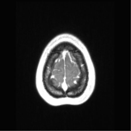File:Central neurocytoma (Radiopaedia 37664-39557 Axial T1 C+ 73).png