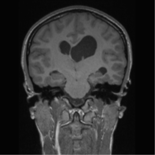 Central neurocytoma (Radiopaedia 37664-39557 Coronal T1 42).png