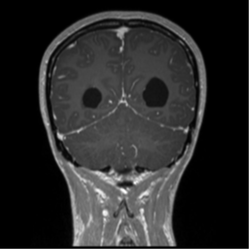 Central neurocytoma (Radiopaedia 37664-39557 Coronal T1 C+ 23).png