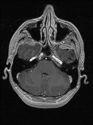 Central neurocytoma (Radiopaedia 56690-63469 Axial T1 C+ 40).jpg
