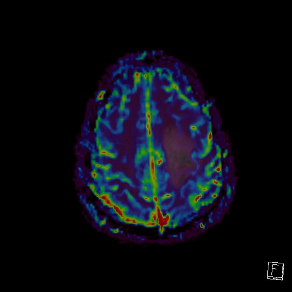 Central neurocytoma (Radiopaedia 84497-99872 Axial Perfusion 59).jpg