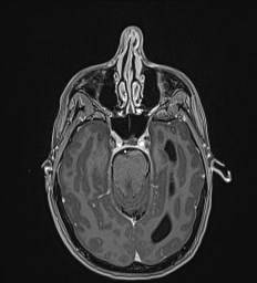 Central neurocytoma (Radiopaedia 84497-99872 Axial T1 C+ 53).jpg