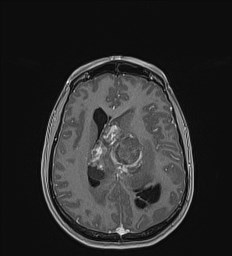 Central neurocytoma (Radiopaedia 84497-99872 Axial T1 C+ 96).jpg