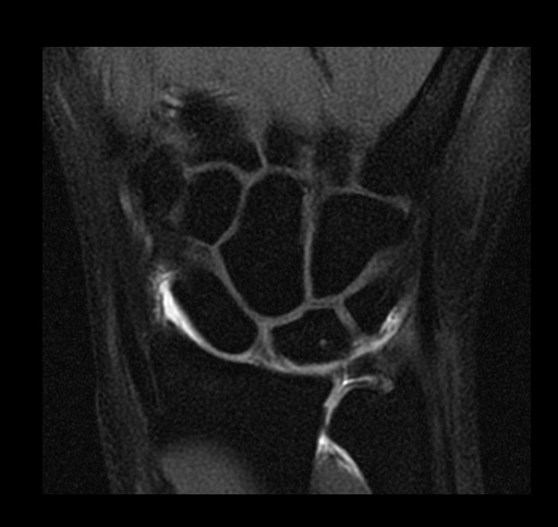 File:Central triangular fibrocartilage perforation (Radiopaedia 73346-84130 Coronal T1 fat sat 7).jpg