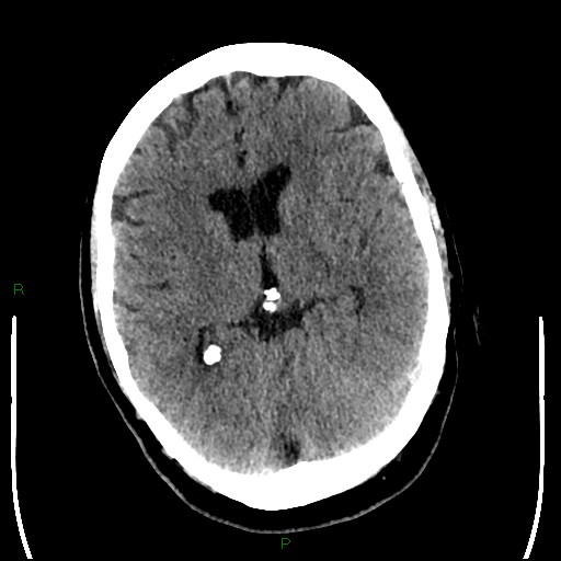 Cerebellar abscess (Radiopaedia 78135-90671 Axial non-contrast 55).jpg