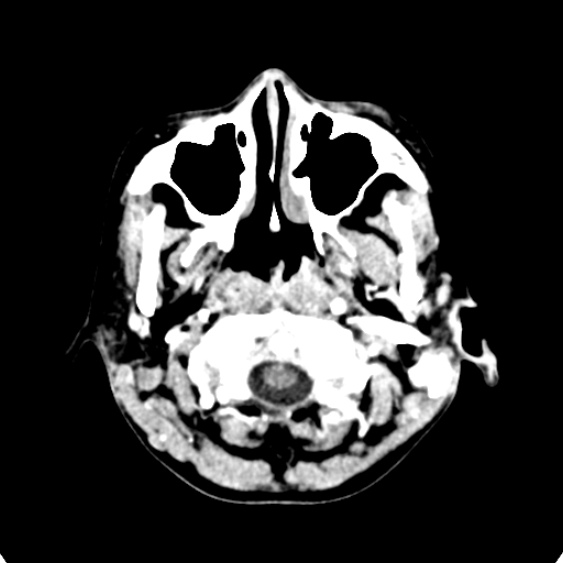 Cerebellar abscess secondary to mastoiditis (Radiopaedia 26284-26412 Axial C+ delayed 7).jpg