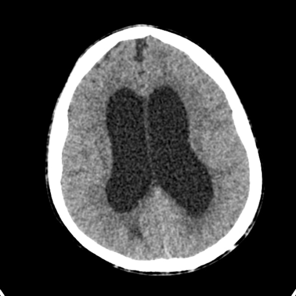 Cerebellar abscess secondary to mastoiditis (Radiopaedia 26284-26412 Axial non-contrast 101).jpg