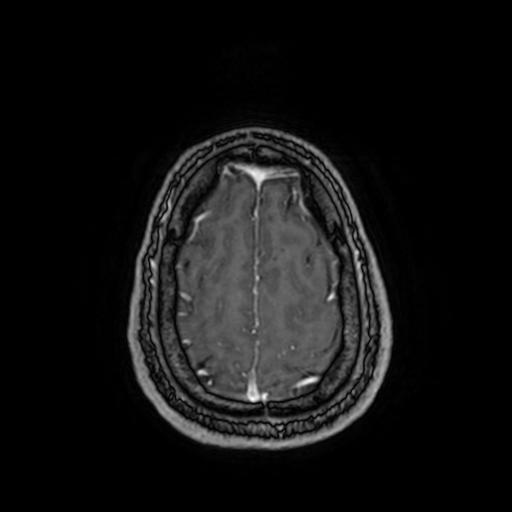 File:Cerebellar hemangioblastoma (Radiopaedia 88055-104622 Axial T1 C+ 149).jpg