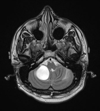 File:Cerebellar hemangioblastomas and pituitary adenoma (Radiopaedia 85490-101176 Axial T2 7).png