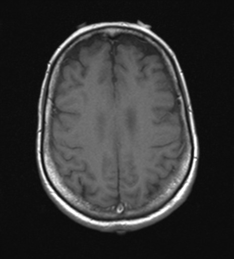 File:Cerebellar metastases (Radiopaedia 24038-24249 Axial T1 2).jpg
